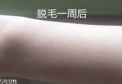 silkn脱毛仪有用吗?可以永久脱毛一劳永逸吗?