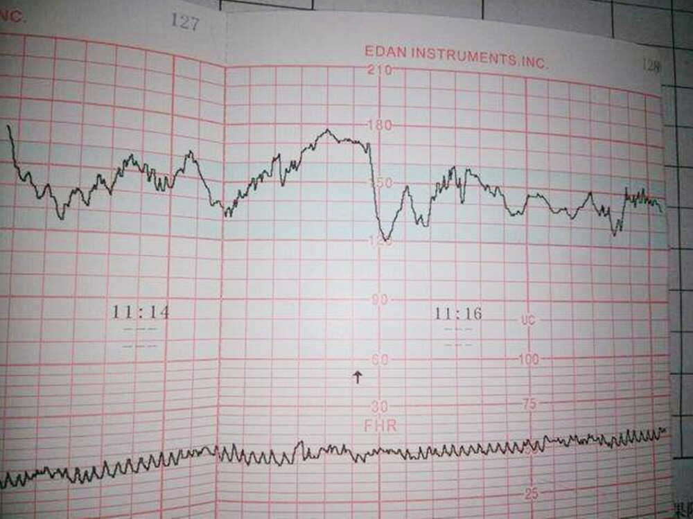 胎心监护图怎么看？这几个数据看懂，自己就能了解胎儿的健康情况