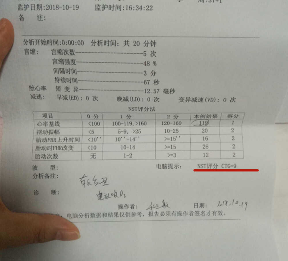 胎心监护图怎么看?这几个数据看懂,自己就能了解胎儿的健康情况