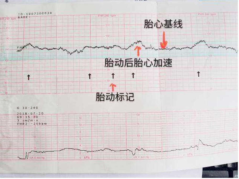 胎心监护图怎么看？这几个数据看懂，自己就能了解胎儿的健康情况