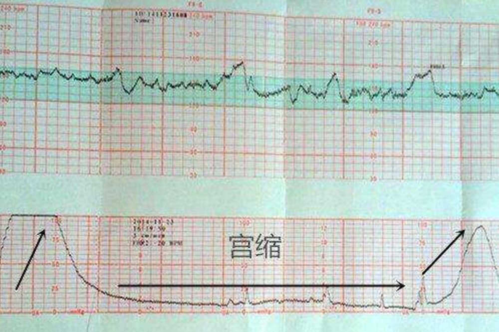 胎心监护图怎么看？这几个数据看懂，自己就能了解胎儿的健康情况