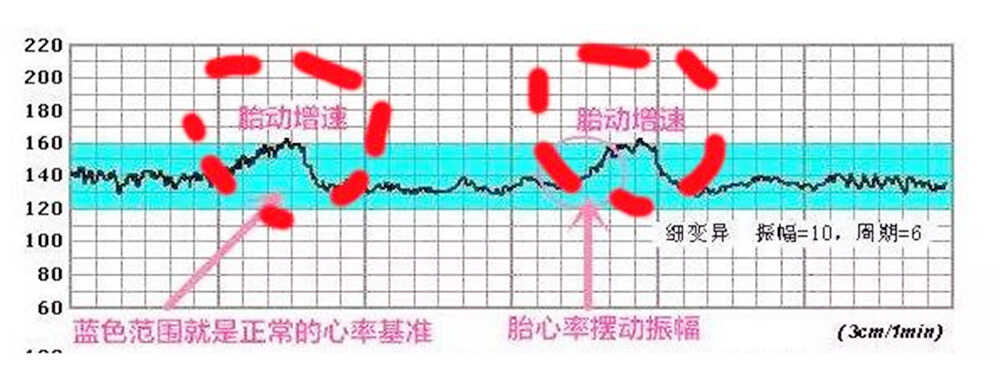胎心监护图怎么看?这几个数据看懂,自己就能了解胎儿的健康情况