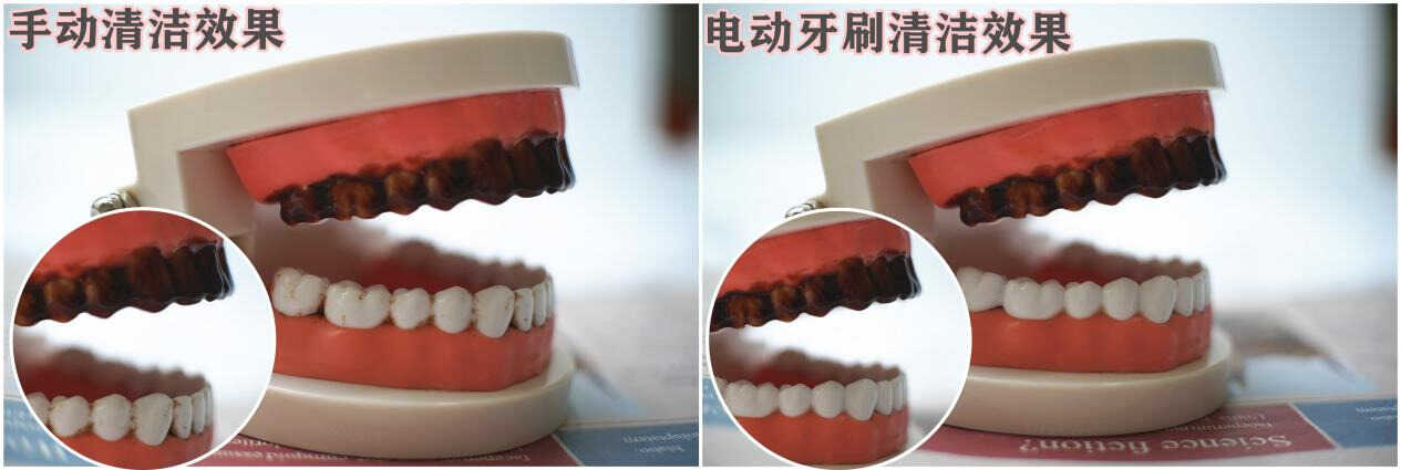 牙医科普:电动牙刷的正确使用方法:严防三大伤牙弊端