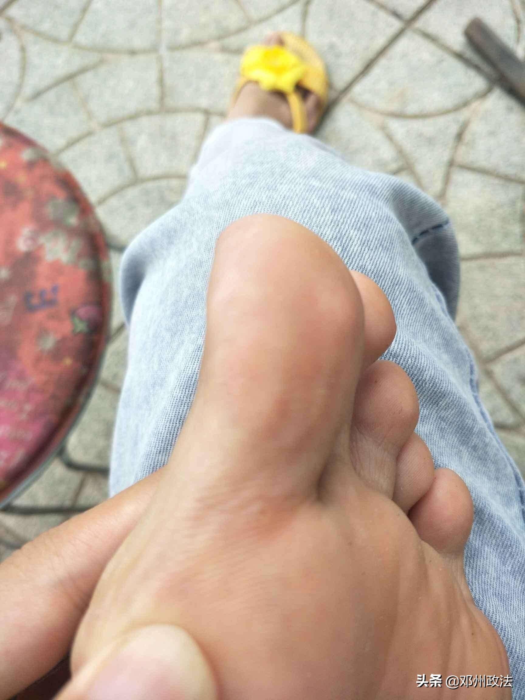 脚上起小水泡很痒是怎么回事？是不是穿鞋捂的？