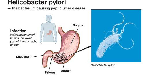 呼气试验结果越大,幽门螺旋杆菌感染就越重?在线医生请别乱说