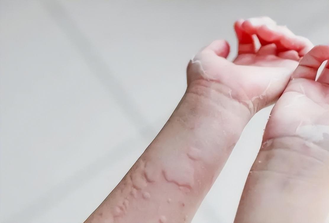 得了荨麻疹能治好吗?治疗方法有5点,一文说清