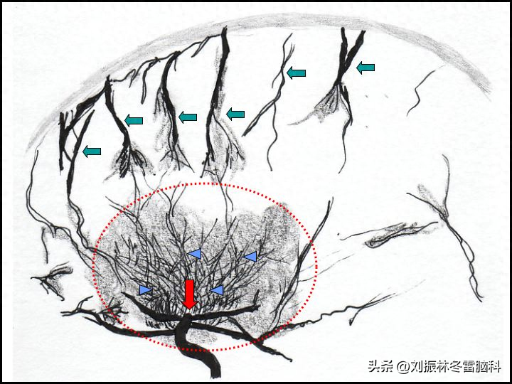 没有症状的烟雾病需要手术吗？