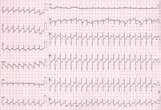 胸闷心悸看急诊 病因却藏的有点深!