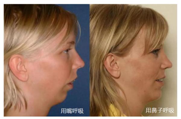 鼻炎患者自学4招，让鼻子快速通气