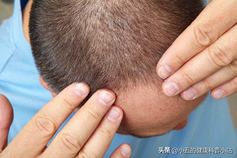 非那雄胺是治疗前列腺增生、溢脂性脱发常用药，科学服用注意4点