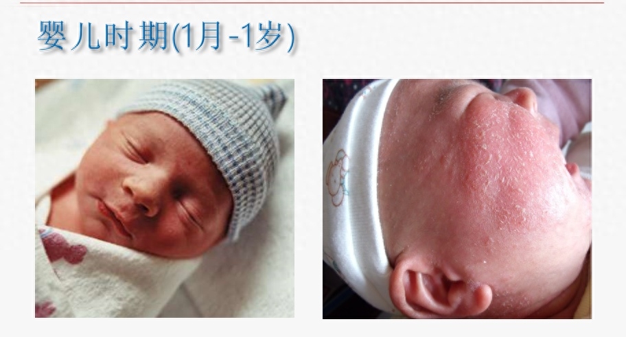 什么是婴幼儿湿疹（特应性皮炎），为什么会反反复复？