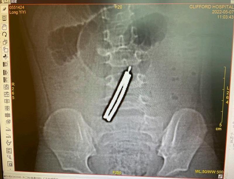 3岁女童误吞11块磁力棒，肠子磨穿5个洞